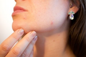 HydraFacial  ,  ,  